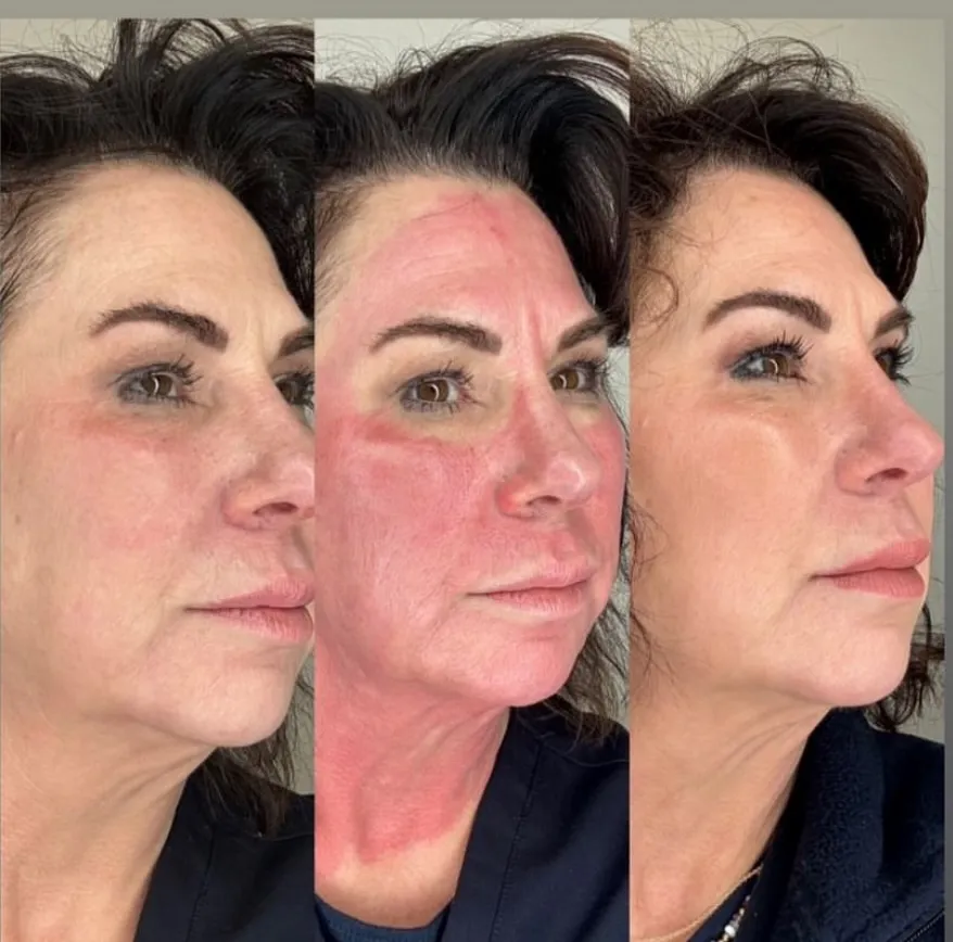 RF microneedling for skin texture, three-quarter view of the cheeks, before and after, at La Miel Aesthetics in Raleigh, NC