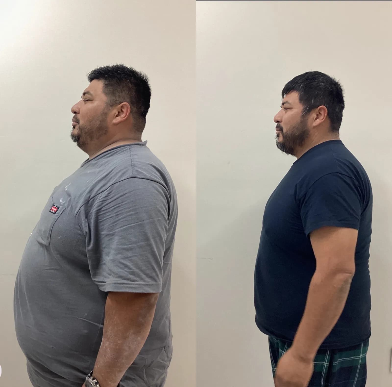 GLP-1 medical weight loss, profile view of the body, before and after, at La Miel Aesthetics in Raleigh, NC