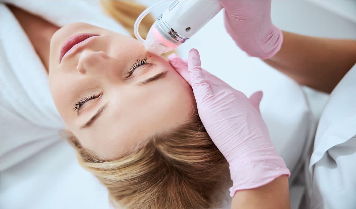 Tratamiento de microneedling para cicatrices de acné en La Miel Aesthetics, spa médico en Raleigh, NC.