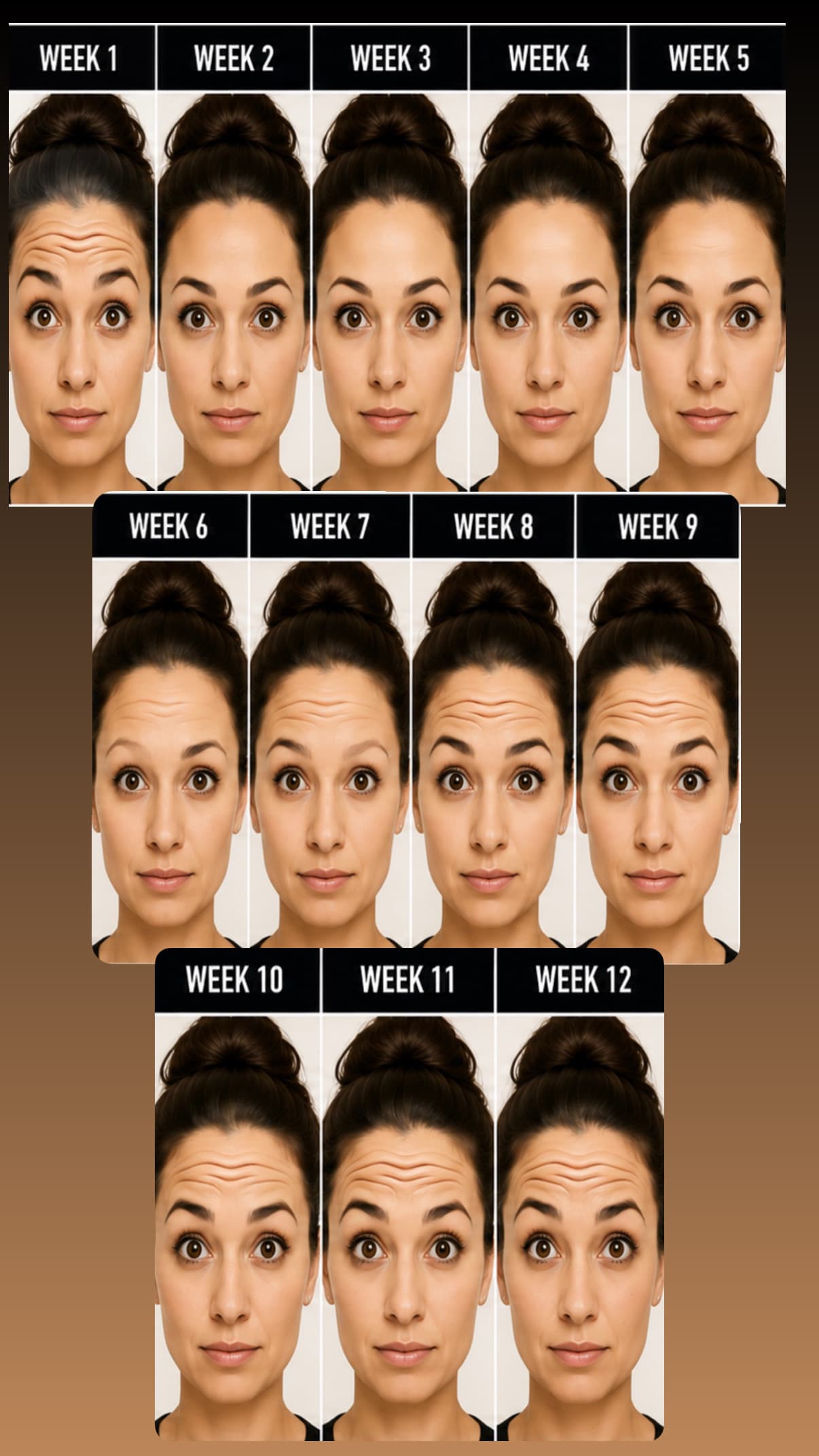 Week by week Botox results timeline showing gradual smoothing from week 1 through week 12 at La Miel Aesthetics Raleigh NC